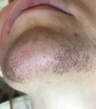 Before ScarletElectrolysis.com Chin Hair Removal