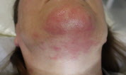 After ScarletElectrolysis.com Chin Hair Removal
